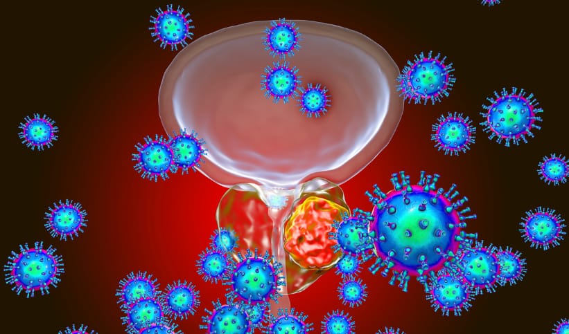 Les différents stades du cancer de la prostate